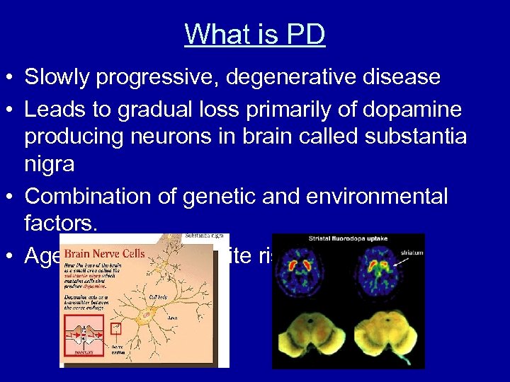 What is PD • Slowly progressive, degenerative disease • Leads to gradual loss primarily