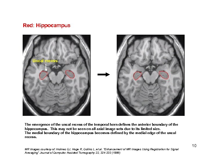 Red: Hippocampus Medial edge of Uncal recess. Recess Uncal The emergence of the uncal