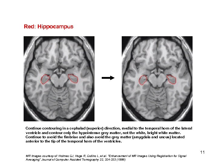 Red: Hippocampus Continue contouring in a cephalad (superior) direction, medial to the temporal horn