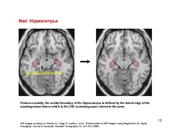 Red: Hippocampus Quadrageminal cistern Postero-cranially, the medial boundary of the hippocampus is defined by