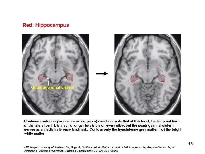 Red: Hippocampus Quadrageminal cistern Continue contouring in a cephalad (superior) direction; note that at