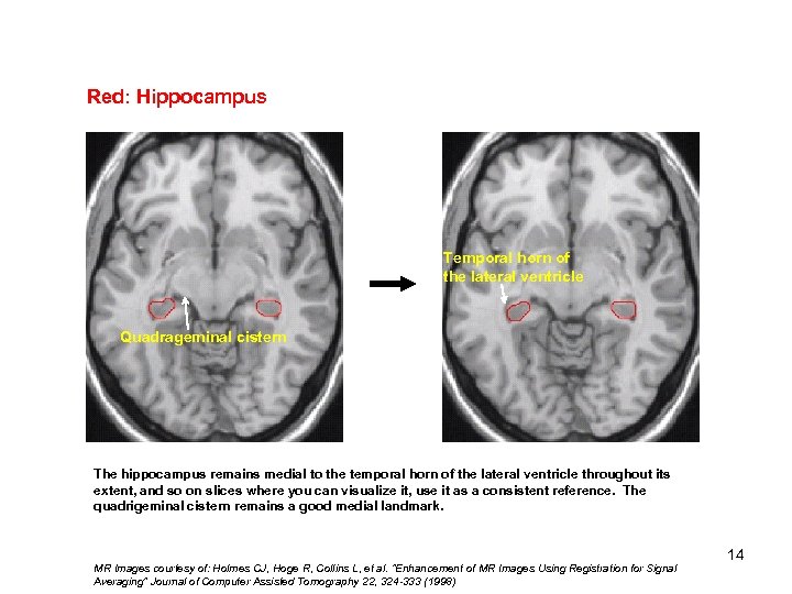 Red: Hippocampus Temporal horn of the lateral ventricle Quadrageminal cistern The hippocampus remains medial