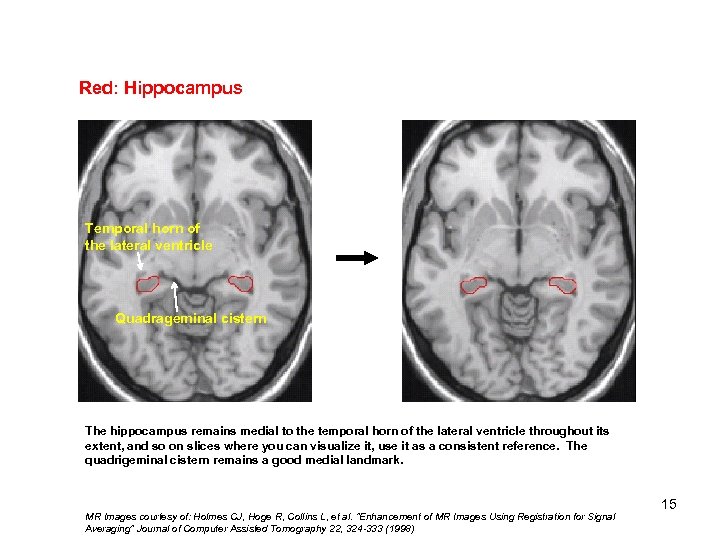 Red: Hippocampus Temporal horn of the lateral ventricle Quadrageminal cistern The hippocampus remains medial