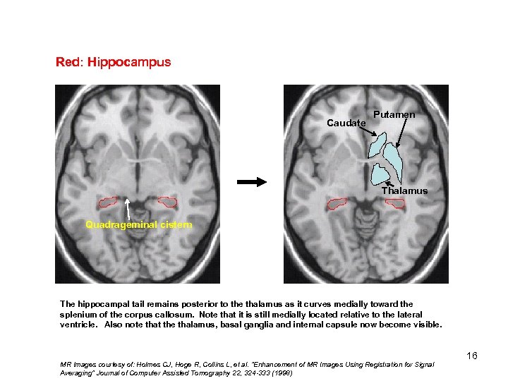 Red: Hippocampus Caudate Putamen Thalamus Quadrageminal cistern The hippocampal tail remains posterior to the