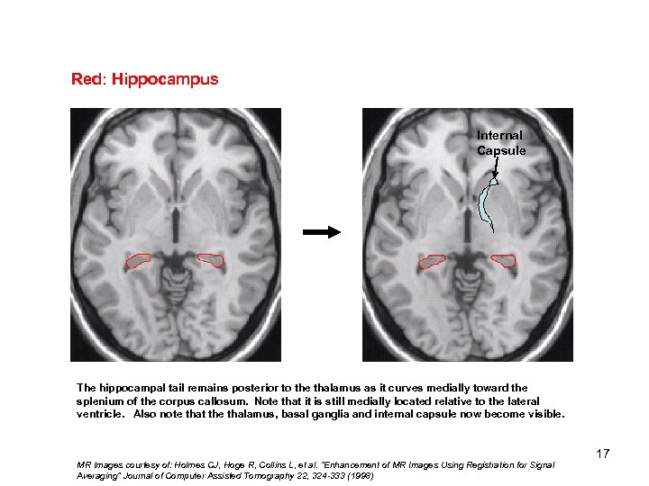 Red: Hippocampus Internal Capsule The hippocampal tail remains posterior to the thalamus as it