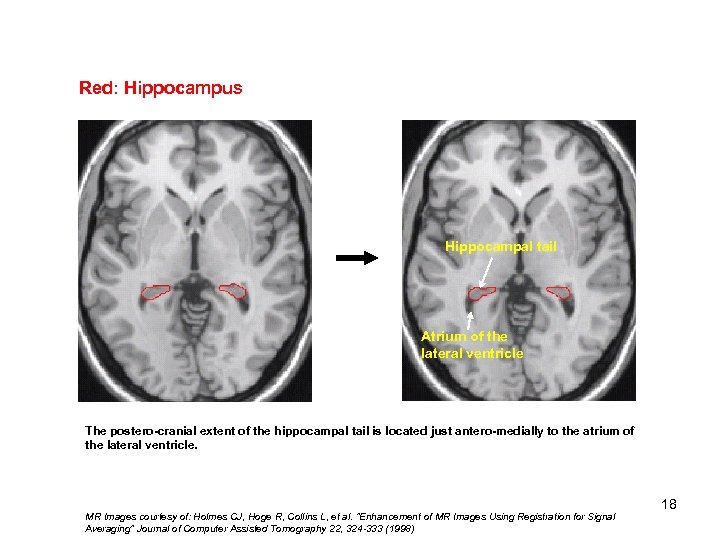 Red: Hippocampus Hippocampal tail Atrium of the lateral ventricle The postero-cranial extent of the