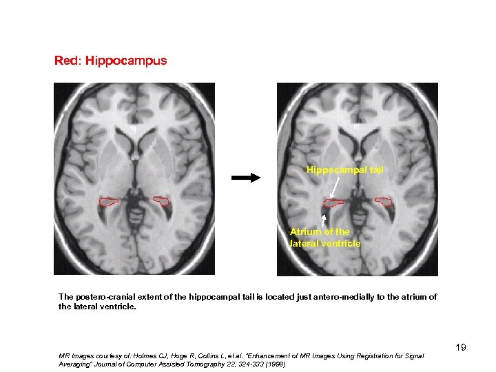 Red: Hippocampus Hippocampal tail Atrium of the lateral ventricle The postero-cranial extent of the