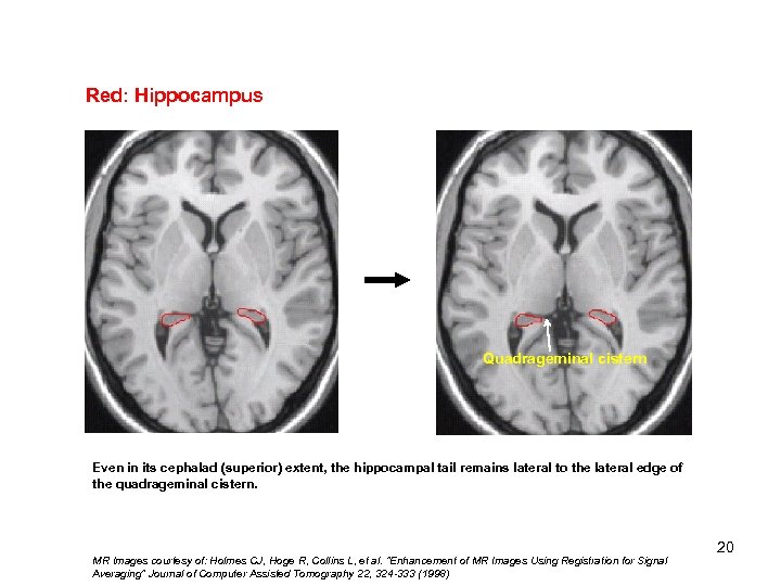 Red: Hippocampus Quadrageminal cistern Even in its cephalad (superior) extent, the hippocampal tail remains