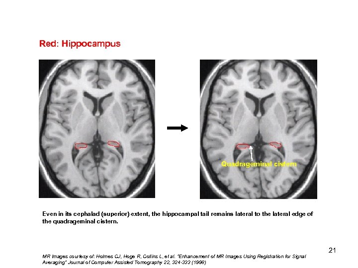 Red: Hippocampus Quadrageminal cistern Even in its cephalad (superior) extent, the hippocampal tail remains