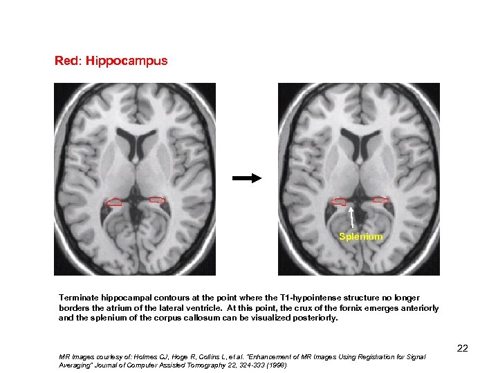 Red: Hippocampus Splenium Terminate hippocampal contours at the point where the T 1 -hypointense