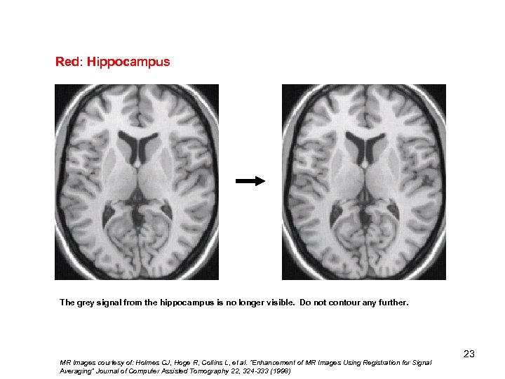 Red: Hippocampus The grey signal from the hippocampus is no longer visible. Do not