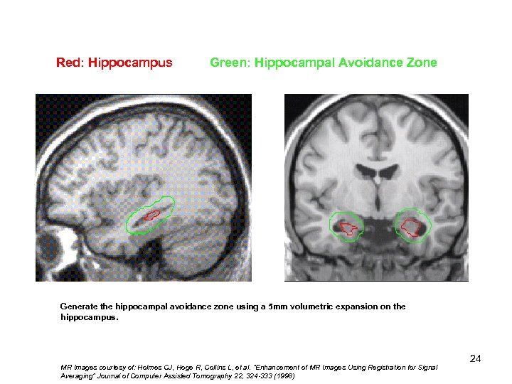 Red: Hippocampus Green: Hippocampal Avoidance Zone Generate the hippocampal avoidance zone using a 5