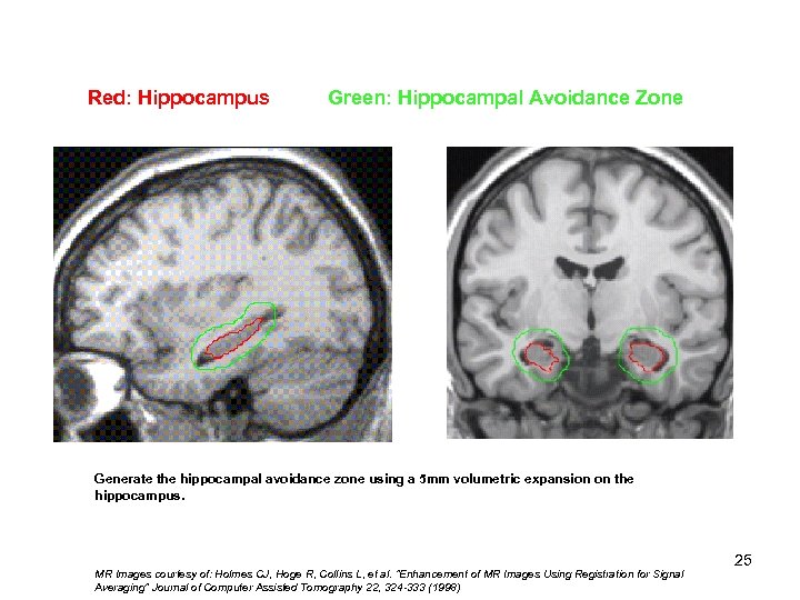 Red: Hippocampus Green: Hippocampal Avoidance Zone Hippocampal 1) Tail 2) Body 3) Head Generate