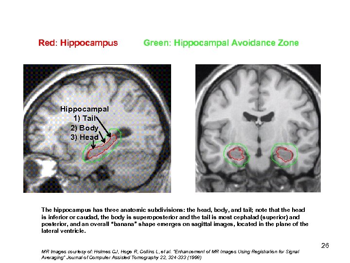 Red: Hippocampus Green: Hippocampal Avoidance Zone Hippocampal 1) Tail 2) 1) Tail Body 2)