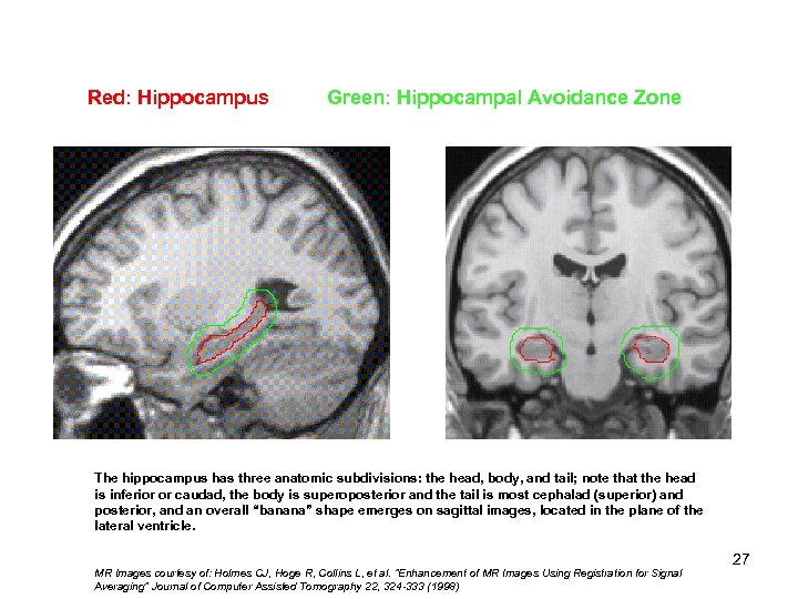 Red: Hippocampus Green: Hippocampal Avoidance Zone Hippocampal 1) Tail 2) Body 3) Head The