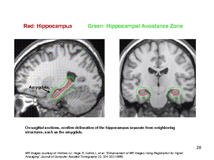 Red: Hippocampus Green: Hippocampal Avoidance Zone Hippocampal 1) Tail 2) Body 3) Head Amygdala