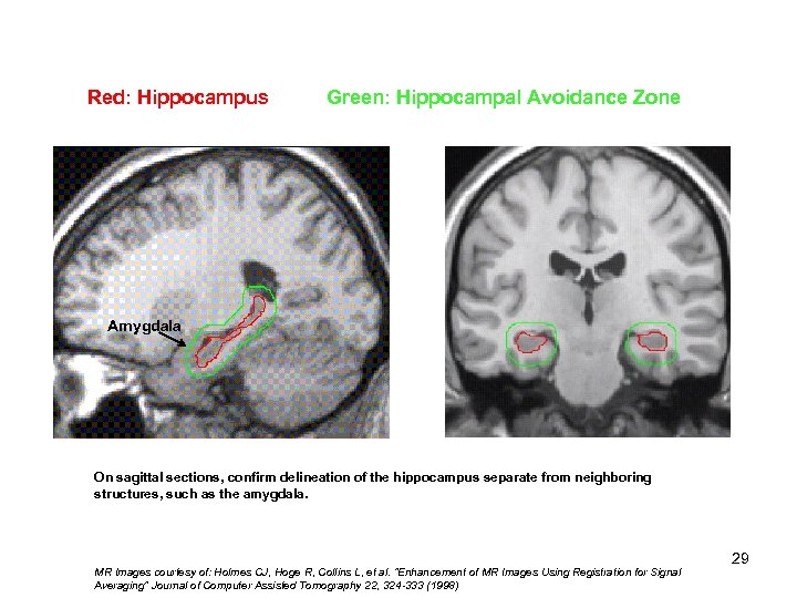 Red: Hippocampus Green: Hippocampal Avoidance Zone Hippocampal 1) Tail 2) Body 3) Head Amygdala