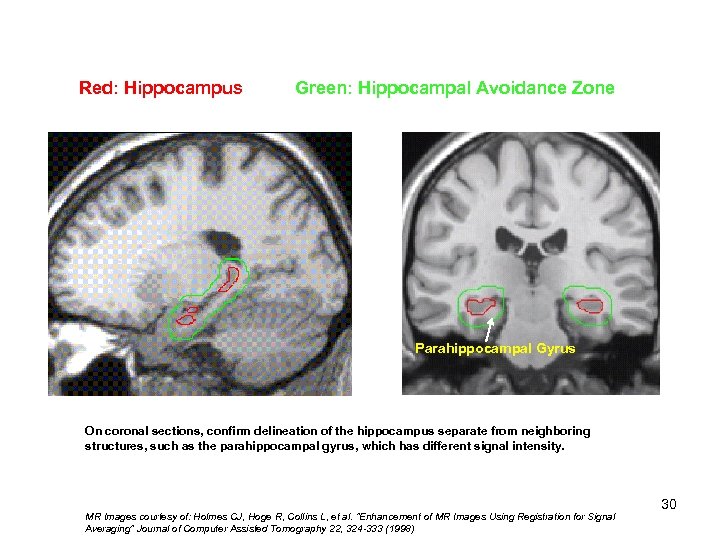 Red: Hippocampus Green: Hippocampal Avoidance Zone Hippocampal 1) Tail 2) Body 3) Head Parahippocampal