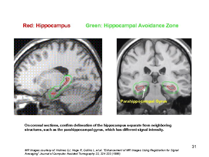 Red: Hippocampus Green: Hippocampal Avoidance Zone Hippocampal 1) Tail 2) Body 3) Head Parahippocampal