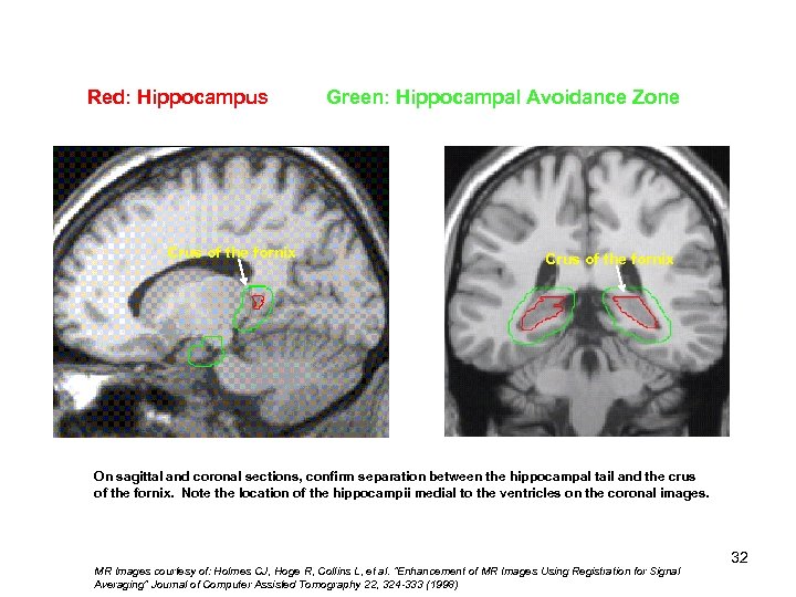 Red: Hippocampus Hippocampal 1)Crus of the fornix Tail 2) Body 3) Head Green: Hippocampal