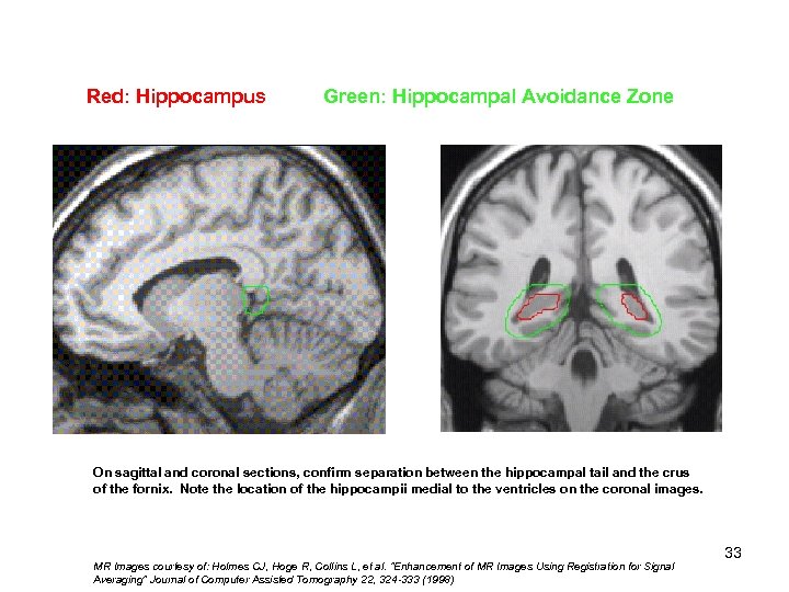 Red: Hippocampus Green: Hippocampal Avoidance Zone Hippocampal 1) Tail 2) Body 3) Head On