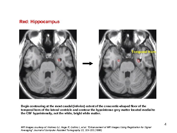 Red: Hippocampus Temporal Horn Begin contouring at the most caudal (inferior) extent of the