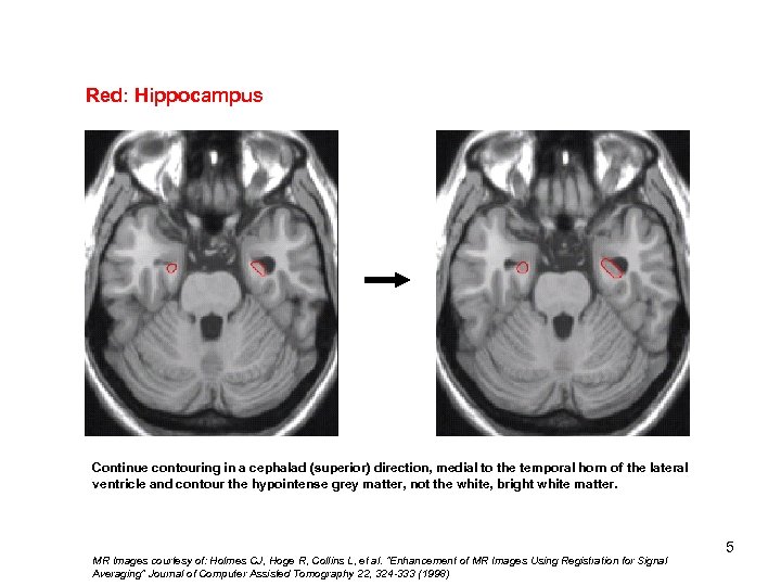 Red: Hippocampus Fimbriae Continue contouring in a cephalad (superior) direction, medial to the temporal