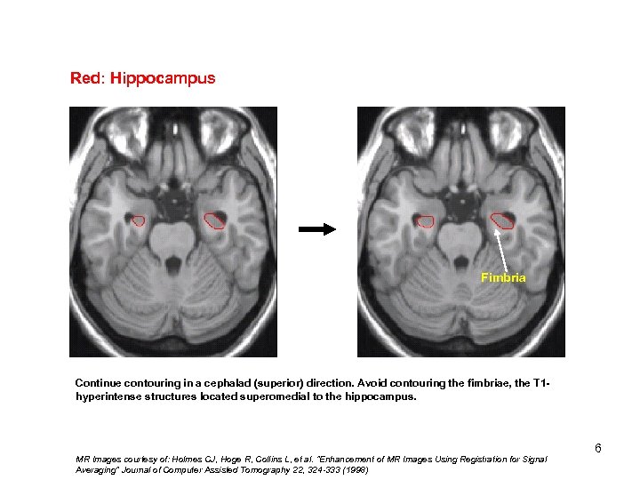 Red: Hippocampus Fimbria Continue contouring in a cephalad (superior) direction. Avoid contouring the fimbriae,