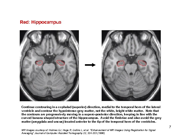 Red: Hippocampus Continue contouring in a cephalad (superior) direction, medial to the temporal horn