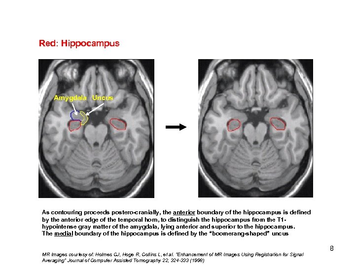 Red: Hippocampus Amygdala Uncus As contouring proceeds postero-cranially, the anterior boundary of the hippocampus