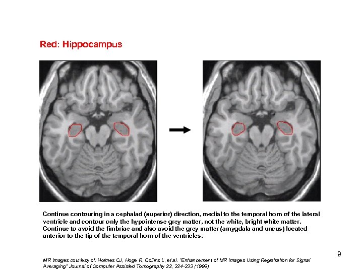 Red: Hippocampus Uncal Recess Continue contouring in a cephalad (superior) direction, medial to the