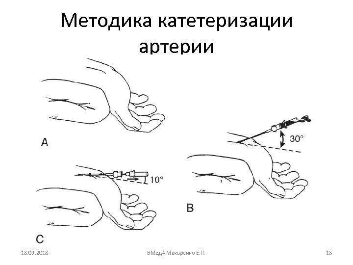 Методика катетеризации артерии 18. 03. 2018 ВМед. А Макаренко Е. П. 18 