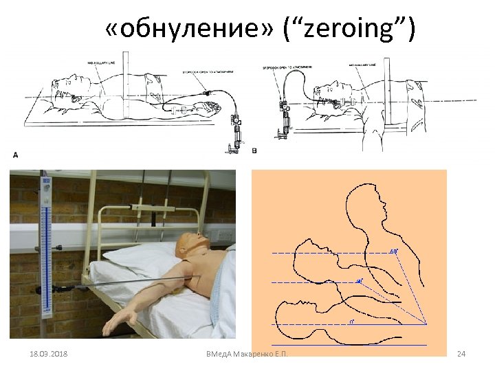  «обнуление» (“zeroing”) 18. 03. 2018 ВМед. А Макаренко Е. П. 24 