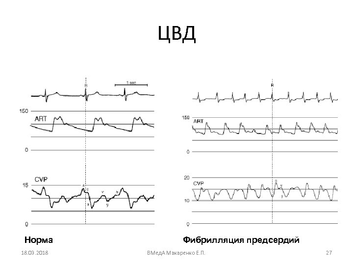 ЦВД Норма 18. 03. 2018 Фибрилляция предсердий ВМед. А Макаренко Е. П. 27 