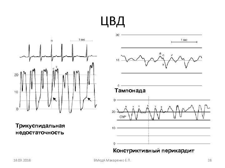 ЦВД Тампонада Трикуспидальная недостаточность Констриктивный перикардит 18. 03. 2018 ВМед. А Макаренко Е. П.