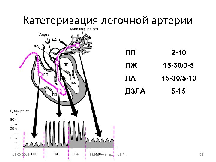 Катетеризация легочной артерии ПП 2 -10 ПЖ 15 -30/0 -5 ЛА 15 -30/5 -10