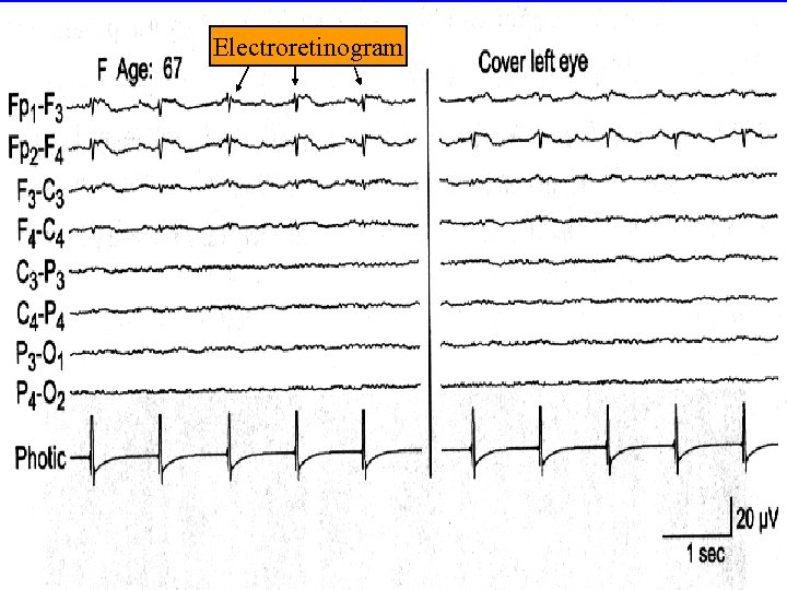 Electroretinogram 