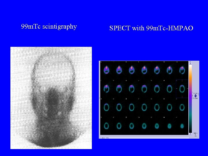 99 m. Tc scintigraphy SPECT with 99 m. Tc-HMPAO 