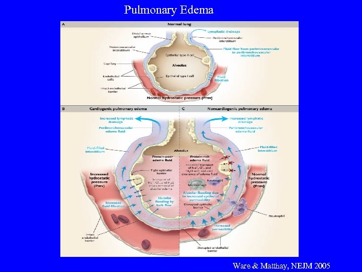 Pulmonary Edema Ware & Matthay, NEJM 2005 