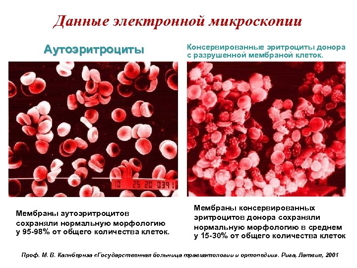 Данные электронной микроскопии Аутоэритроциты Мембраны аутоэритроцитов сохраняли нормальную морфологию у 95 -98% от общего