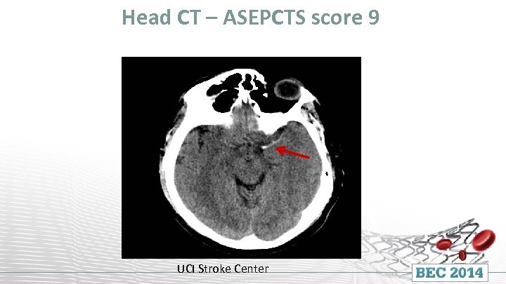 Head CT – ASEPCTS score 9 UCI Stroke Center 