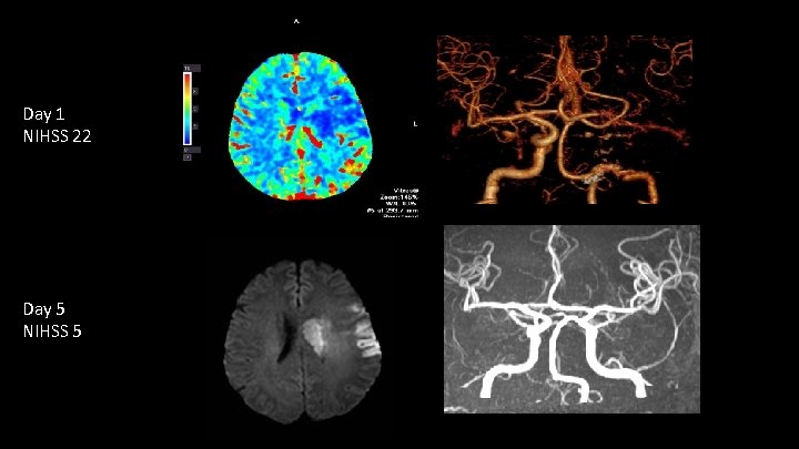 Day 1 NIHSS 22 Day 5 NIHSS 5 UCI Stroke Center 