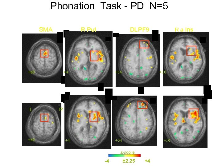 Phonation Task - PD N=5 Pre-LSVT SMA R Put +60 DLPF 9 + +4