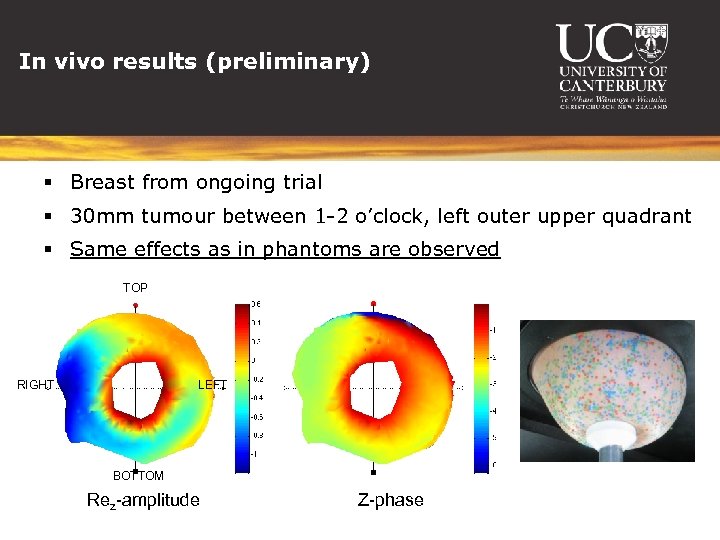 In vivo results (preliminary) § Breast from ongoing trial § 30 mm tumour between