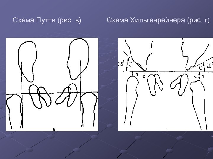 Схема Путти (рис. в) Схема Хильгенрейнера (рис. г) 