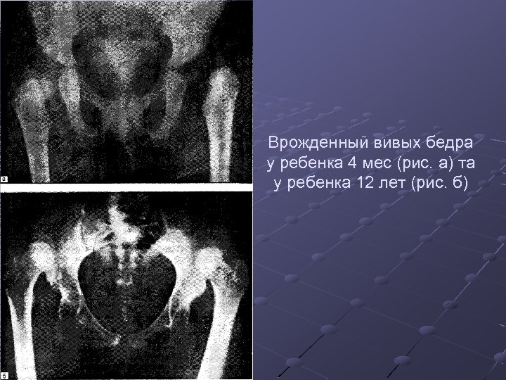 Окостенение головки бедренной кости. Ядра окостенения головок бедренных костей. Ядра окостенения головок. Ядро окостенения головки бедра. Ядро оссификации головки бедренной кости.