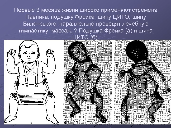 Первые 3 месяца жизни широко применяют стремена Павлика, подушку Фрейка, шину ЦИТО, шину Виленського,