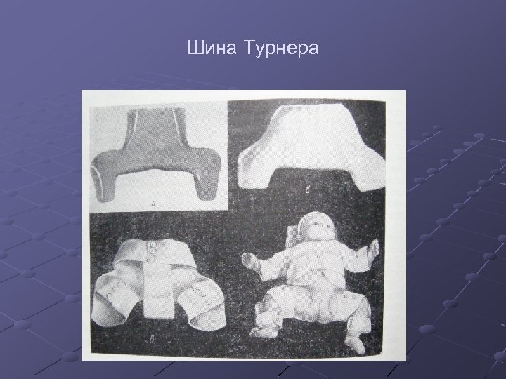 Шина Турнера 
