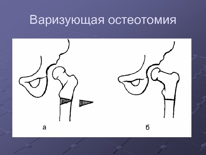 Варизующая остеотомия 