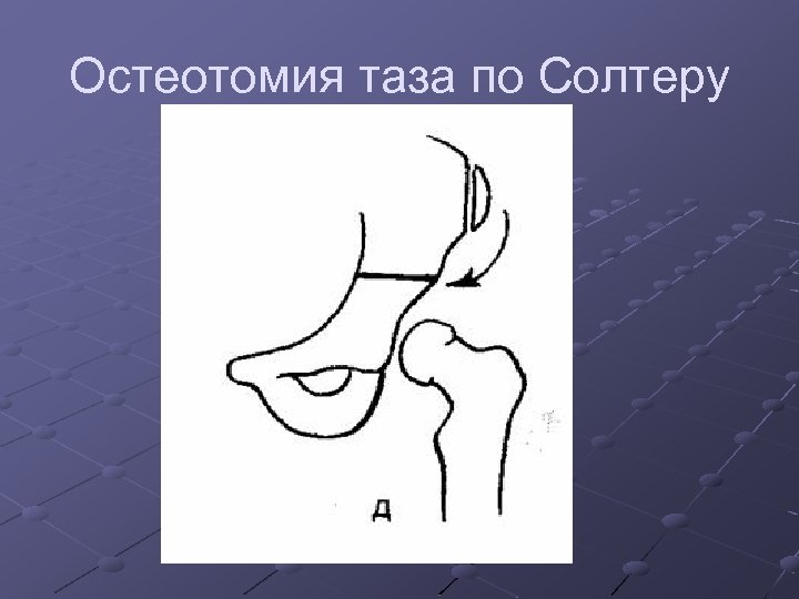 Остеотомия таза по Солтеру 